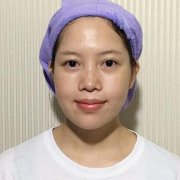 oe冷光子嫩肤仪美白嫩肤案例：两个疗程一万二 width=