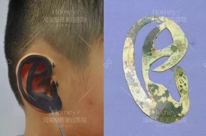 张正文答患者问：“再造的耳朵”和真耳朵一样吗？