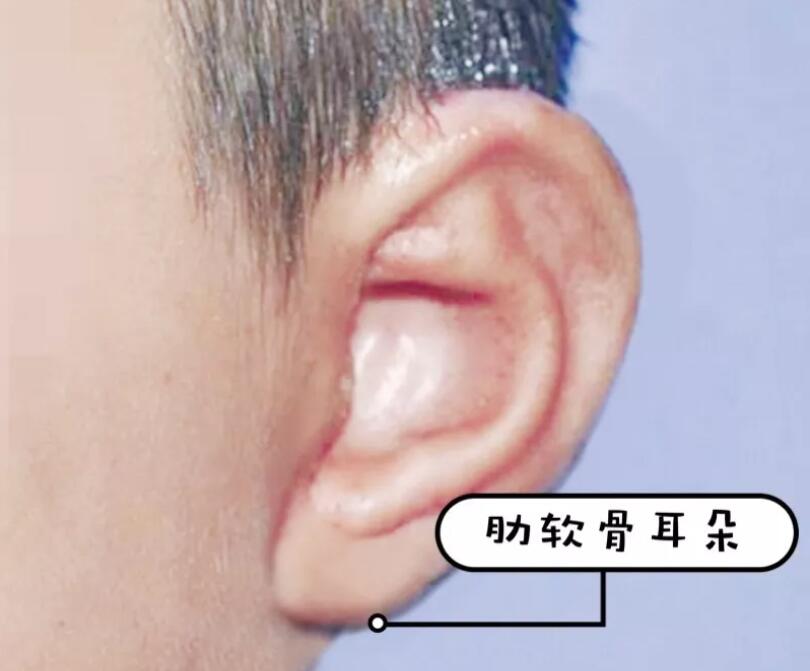 张正文答患者问：“再造的耳朵”和真耳朵一样吗？