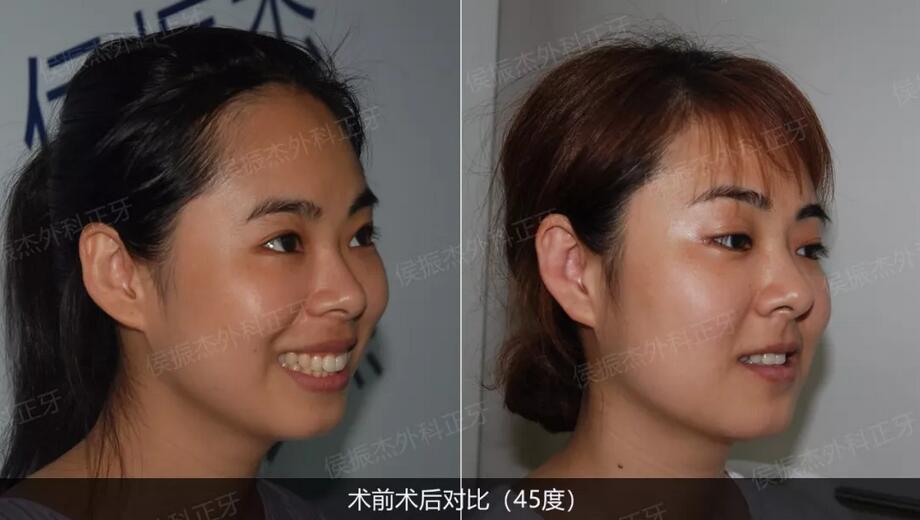 侯振杰外科正牙靠谱吗？侯振杰正牙案例图~