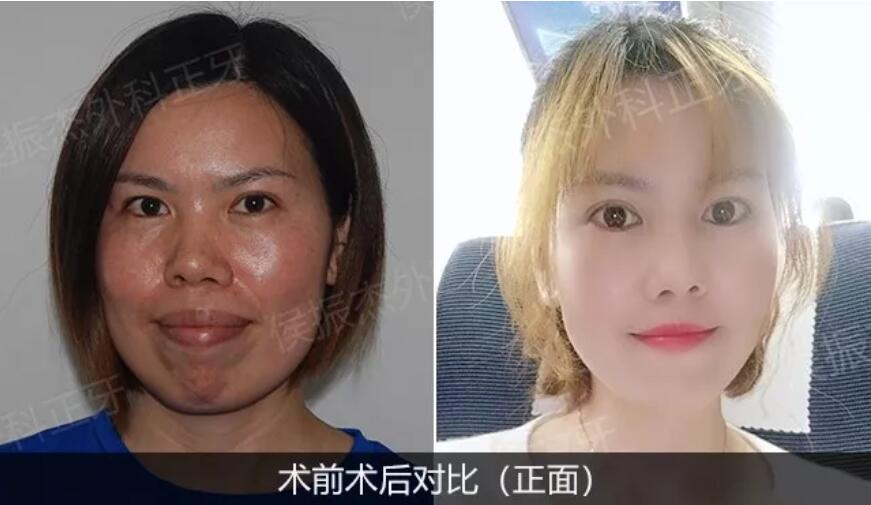 侯振杰外科正牙靠谱吗？侯振杰正牙案例图~