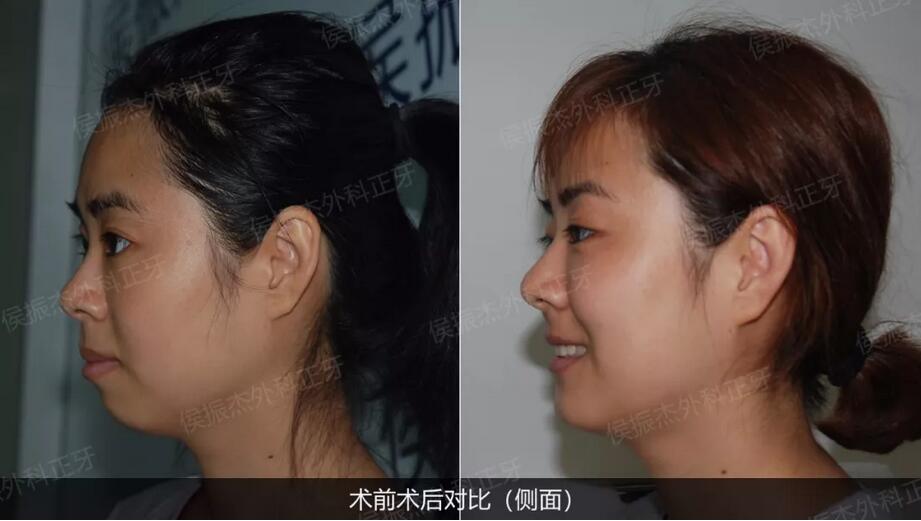 侯振杰外科正牙靠谱吗？侯振杰正牙案例图~