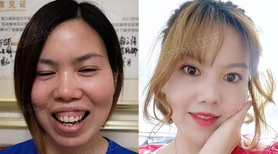 侯振杰外科正牙靠谱吗？侯振杰正牙案例图~