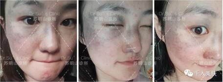 祛太田痣案例一则——再见了，我的“丑姑娘”！