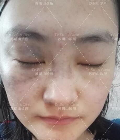 祛太田痣案例一则——再见了，我的“丑姑娘”！