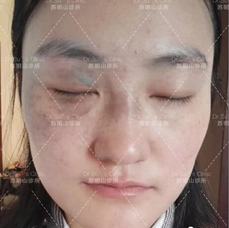祛太田痣案例一则——再见了，我的“丑姑娘”！