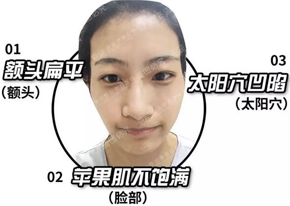 青岛伊美尔整形刘长发心形脸自体脂肪填充21天全记录~