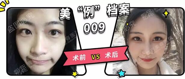 青岛伊美尔整形刘长发心形脸自体脂肪填充21天全记录~