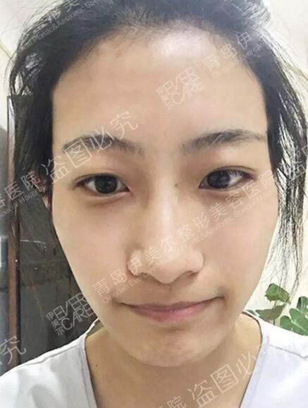 青岛伊美尔整形刘长发心形脸自体脂肪填充21天全记录~