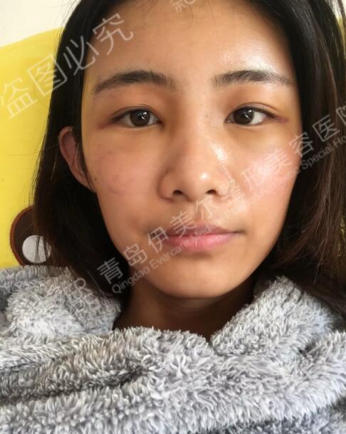 青岛伊美尔整形刘长发心形脸自体脂肪填充21天全记录~