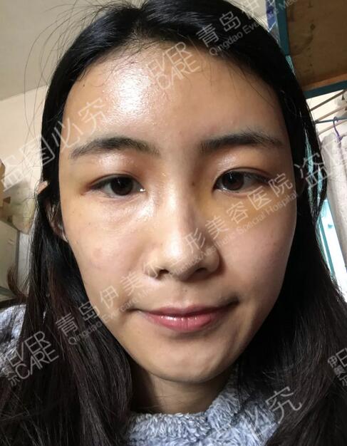 青岛伊美尔整形刘长发心形脸自体脂肪填充21天全记录~