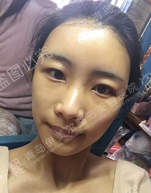 青岛伊美尔整形刘长发心形脸自体脂肪填充21天全记录~