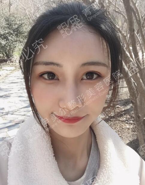 青岛伊美尔整形刘长发心形脸自体脂肪填充21天全记录~