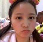 苏李秀英医院怎么样？祛痘印实力如何？