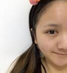 苏李秀英医院怎么样？祛痘印实力如何？