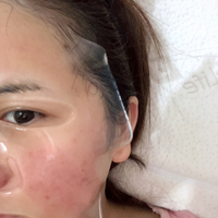 苏李秀英医院怎么样？祛痘印实力如何？