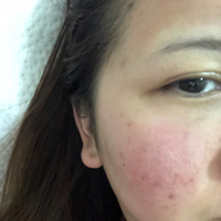 苏李秀英医院怎么样？祛痘印实力如何？