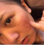 苏李秀英医院怎么样？祛痘印实力如何？