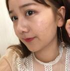 苏李秀英医院怎么样？祛痘印实力如何？