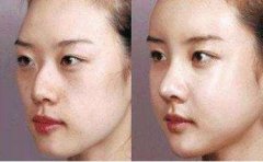 驼峰鼻矫正价钱大概是多少? width=