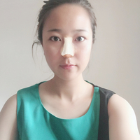 冯雁平隆鼻案例分享，冯雁平造就了现在的我