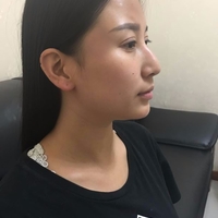 伊美尔长岛医院国字脸整形技术如何?真人案例展示