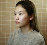 北京基础美整形医院切开双眼皮87天恢复过程~ width=