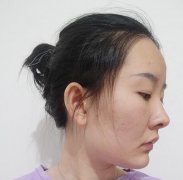 赵小忠埋线提升提升案例贴：75天改变早衰现象的神器 width=