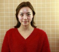 汕头名流整形医院双眼皮案例：内附先后恢复对比图 width=