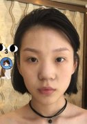 重庆天妃整形美容医院垫鼻梁前后照片对比图案例 width=
