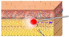 意大利plasma等离子激光光纤溶脂怎么样? width=