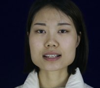 宽下颌角整形案例：63天拯救国字脸恢复对比照 width=