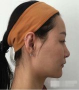 黑脸娃娃适合什么人做?黑脸娃娃真人案例对比分享 width=