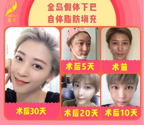 微整形市场潜规则之对整形的偏见，是变美路上******的绊脚石！