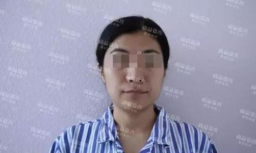 scarpa筋膜隆下颏+面部吸脂+面部脂肪填充真实记录，很详细哦~