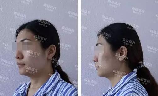 scarpa筋膜隆下颏+面部吸脂+面部脂肪填充真实记录，很详细哦~