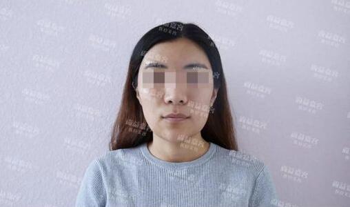 scarpa筋膜隆下颏+面部吸脂+面部脂肪填充真实记录，很详细哦~