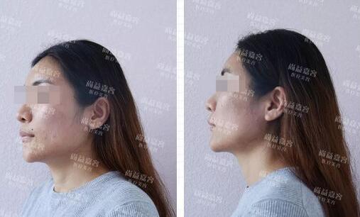 scarpa筋膜隆下颏+面部吸脂+面部脂肪填充真实记录，很详细哦~