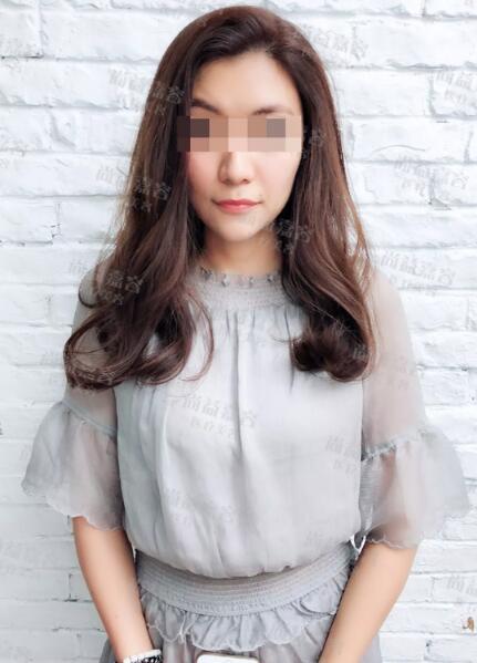scarpa筋膜隆下颏+面部吸脂+面部脂肪填充真实记录，很详细哦~