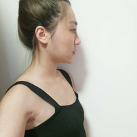 大西北祛眼袋果如何?能抹平岁月的痕迹吗?