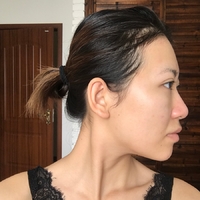 郑州梨花雨整形医院嫩肤技术怎么样?丑小鸭变白天鹅案例分享