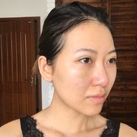 郑州梨花雨整形医院嫩肤技术怎么样?丑小鸭变白天鹅案例分享
