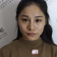 oe冷光子嫩肤仪果如何?价钱贵吗?