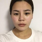 汉密尔顿美容医院韩式切开双眼皮对比照：小手术大改变 width=