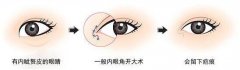 内眦赘皮矫正术方法都有哪些? width=