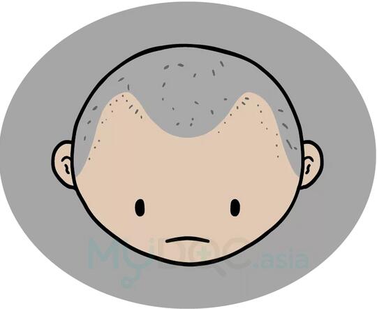 你秃，是遗传了你爸还是你妈？