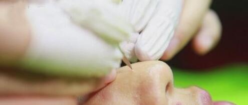 像素激光祛痘疤应该注意哪些?
