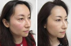 彩光嫩肤要多少钱?性价比高不高哦? width=