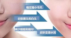 黑脸娃娃收缩毛孔的果好吗?很想去做啊~ width=