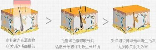 复合彩光脱毛果很不错是真的吗?